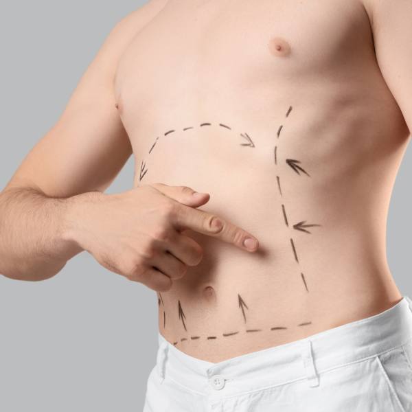 Abdominoplastia